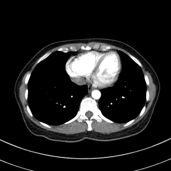 Adenocystic carcinoma of the trachea (Radiopaedia 47677-52525 Axial C+ arterial phase 66).jpg