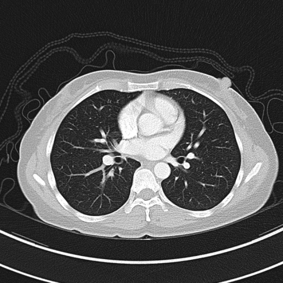 Adenocystic carcinoma of the trachea (Radiopaedia 47677-52525 Axial lung window 54).jpg
