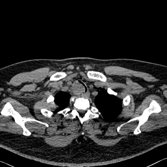 File:Adenoid cystic carcinoma of the trachea (Radiopaedia 49042-54137 Axial non-contrast 30).jpg