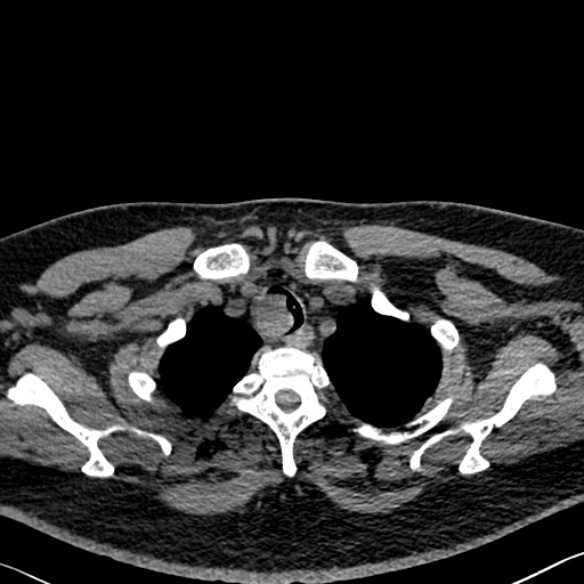File:Adenoid cystic carcinoma of the trachea (Radiopaedia 49042-54137 Axial non-contrast 38).jpg