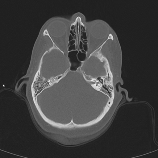 File:Adenoid cystic tumor of palate (Radiopaedia 46980-51518 Axial bone window 13).png