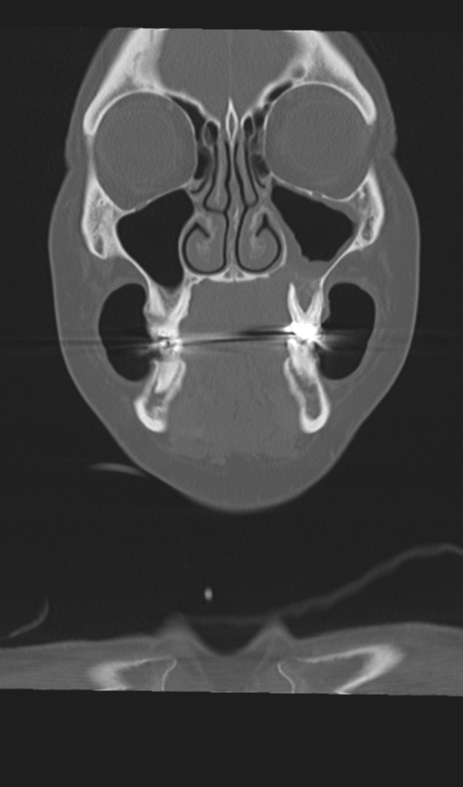 Adenoid cystic tumor of palate (Radiopaedia 46980-51518 Coronal bone window 19).png