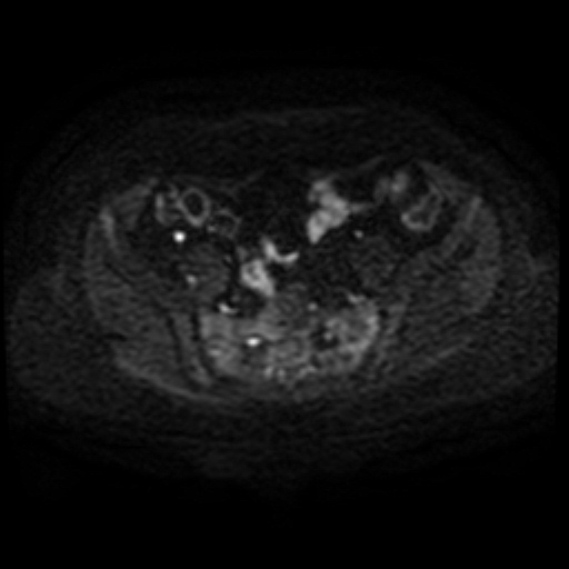 Adenoma malignum of cervix (Radiopaedia 66441-75705 Axial DWI 53).jpg