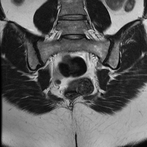 File:Adenoma malignum of cervix (Radiopaedia 66441-75705 Coronal T2 20).jpg