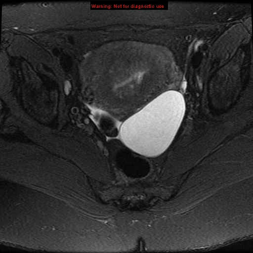 File:Adenomyosis (Radiopaedia 8972-9748 Axial T2 fat sat 5).jpg