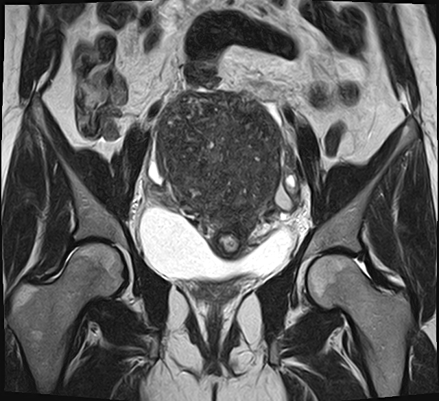 File:Adenomyosis - ovarian endometriomas (Radiopaedia 67031-76350 Coronal T2 14).jpg