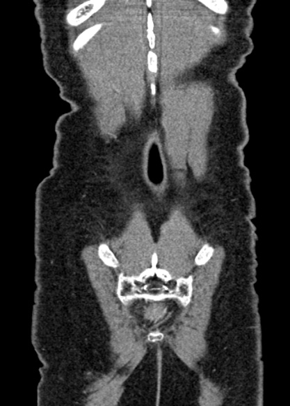 Adhesional small bowel obstruction (Radiopaedia 48397-53305 Coronal C+ portal venous phase 326).jpg