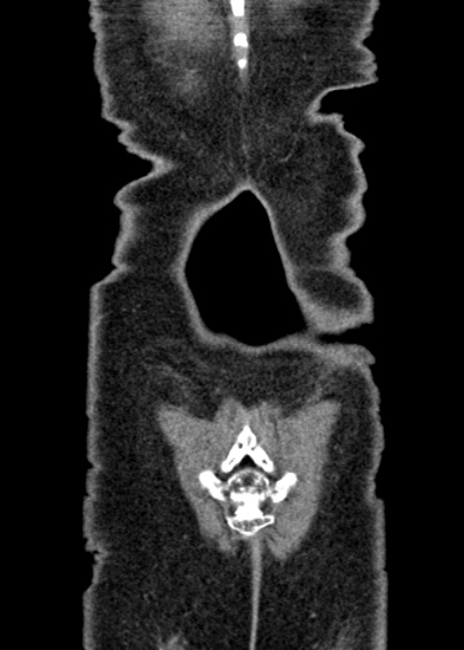 Adhesional small bowel obstruction (Radiopaedia 48397-53305 Coronal C+ portal venous phase 338).jpg