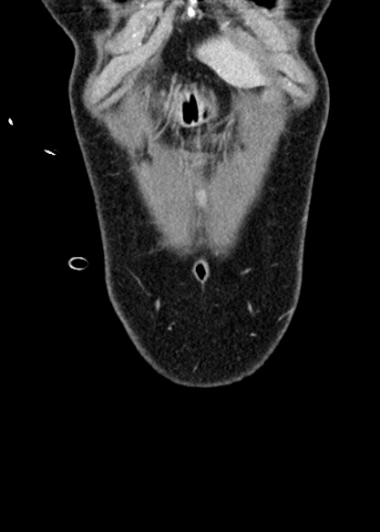 Adhesional small bowel obstruction (Radiopaedia 48397-53305 Coronal C+ portal venous phase 35).jpg