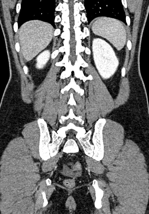 Adhesional small bowel obstruction (Radiopaedia 58900-66131 Coronal C+ portal venous phase 196).jpg