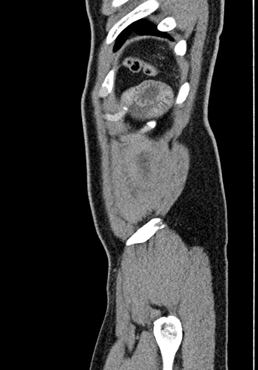 Adhesional small bowel obstruction (Radiopaedia 58900-66131 Sagittal C+ portal venous phase 232).jpg