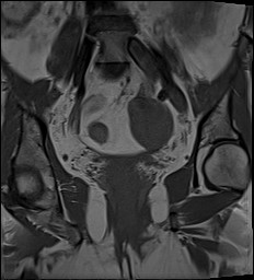 File:Adnexal multilocular cyst (O-RADS US 3- O-RADS MRI 3) (Radiopaedia 87426-103754 Coronal 18).jpg