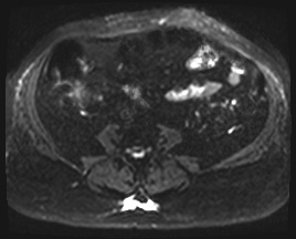 File:Adrenal cortical carcinoma (Radiopaedia 64017-72770 Axial DWI 40).jpg