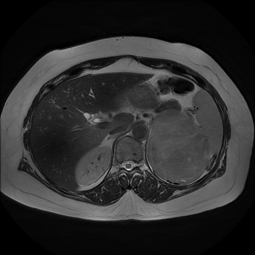 File:Adrenal cortical carcinoma (Radiopaedia 70906-81116 Axial T2 11).jpg