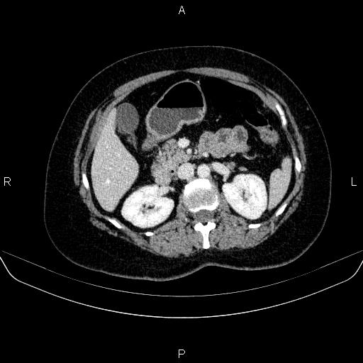 Adrenal cortical carcinoma (Radiopaedia 84882-100379 Axial C+ portal venous phase 34).jpg