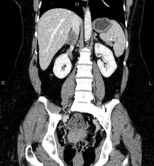 Adrenal cortical carcinoma (Radiopaedia 84882-100379 Coronal C+ portal venous phase 40).jpg