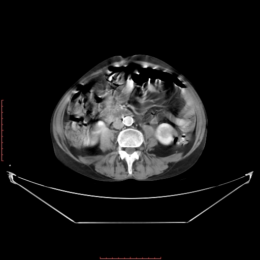 Adrenal hemangioma (Radiopaedia 68923-78668 Axial C+ portal venous phase 41).jpg