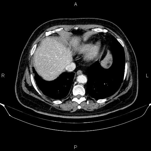 Adrenal hemorrhage (Radiopaedia 62622-70916 Axial C+ portal venous phase 13).jpg