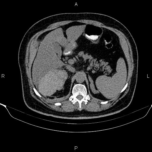 Adrenal hemorrhage (Radiopaedia 62622-70916 Axial non-contrast 54).jpg