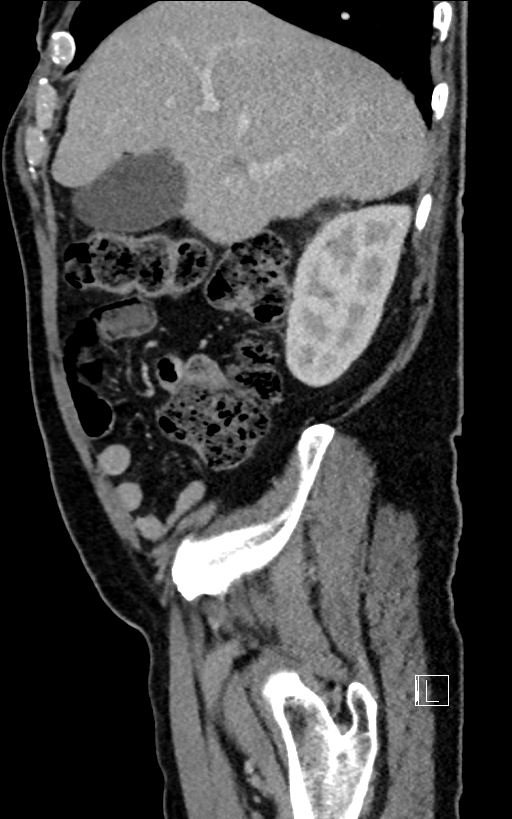 Adrenal lymphoma (Radiopaedia 73730-84529 Sagittal C+ portal venous phase 25).jpg
