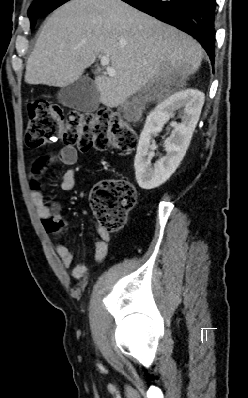 Adrenal lymphoma (Radiopaedia 73730-84529 Sagittal C+ portal venous phase 31).jpg
