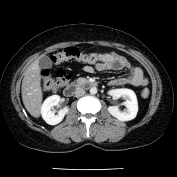 Adrenal myelolipoma (Radiopaedia 43401-46759 Axial C+ portal venous phase 38).jpg