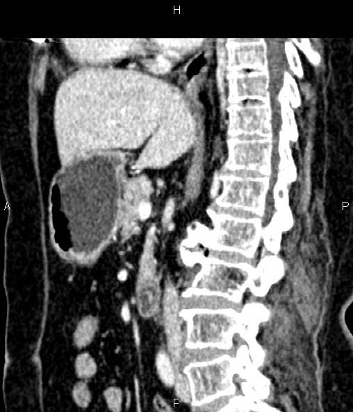 Adrenal myelolipoma (Radiopaedia 82742-96986 Sagittal renal cortical phase 55).jpg