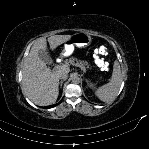 Adrenal myelolipoma (Radiopaedia 84319-99617 Axial With oral contrast 61).jpg