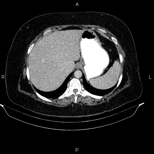 File:Adrenal myelolipoma (Radiopaedia 84319-99617 Axial renal cortical phase 24).jpg