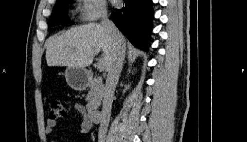 Adrenal myelolipoma (Radiopaedia 84321-99619 Sagittal non-contrast 46).jpg