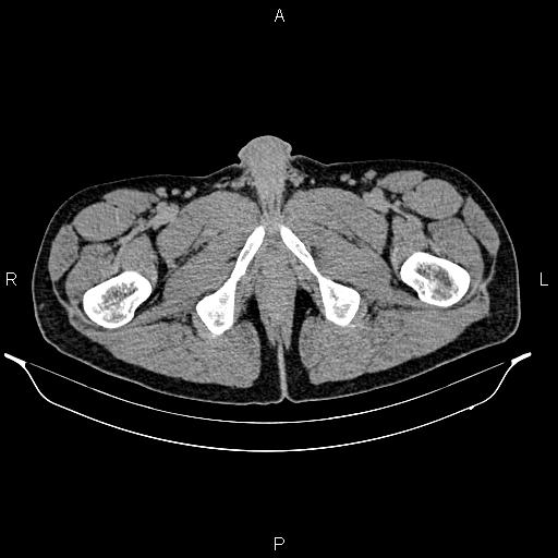 Adrenal myelolipoma (Radiopaedia 87794-104246 Axial renal excretory phase 112).jpg
