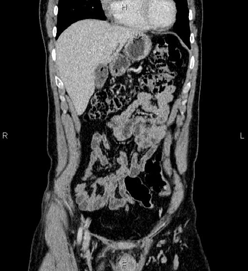 Adrenal myelolipoma (Radiopaedia 87794-104246 Coronal renal cortical phase 15).jpg
