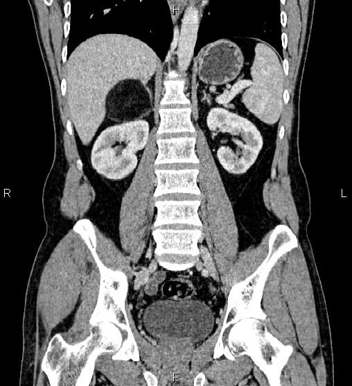 Adrenal myelolipoma (Radiopaedia 87794-104246 Coronal renal cortical phase 40).jpg