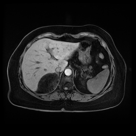 Adrenal myelolipoma - MRI (Radiopaedia 83249-97646 Axial T1 fat sat 18).jpg