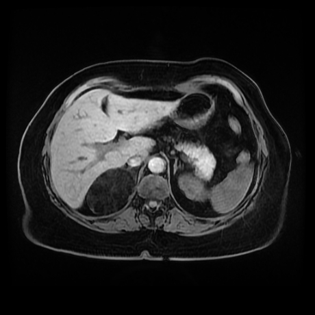 Adrenal myelolipoma - MRI (Radiopaedia 83249-97646 Axial T1 fat sat 23).jpg