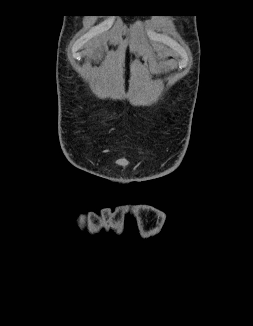 Adrenal myelolipoma - bilateral (Radiopaedia 74805-85810 Coronal C+ portal venous phase 251).jpg