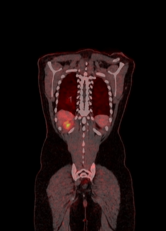 Adrenocortical carcinoma (Radiopaedia 80134-93440 Coronal 159).jpg