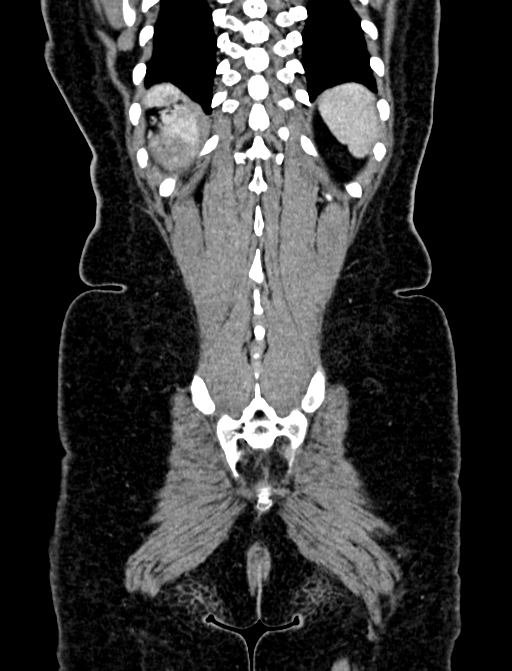 Adrenocortical carcinoma (Radiopaedia 87281-103569 Coronal C+ portal venous phase 136).jpg