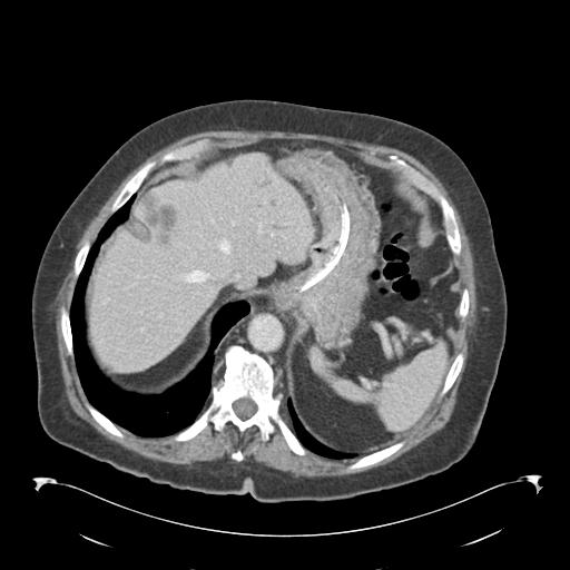 Adult ileal intussusception with secondary obstruction (Radiopaedia 30395-31051 Axial C+ portal venous phase 12).jpg
