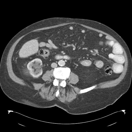 Adult ileal intussusception with secondary obstruction (Radiopaedia 30395-31051 Axial C+ portal venous phase 43).jpg