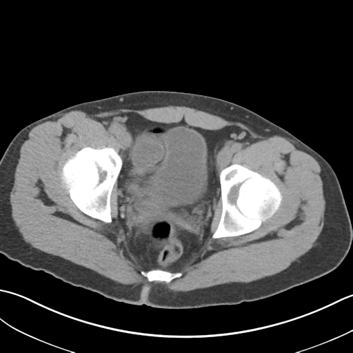 File:Adult polycystic kidney disease (Radiopaedia 47866-52626 Axial non-contrast 78).png