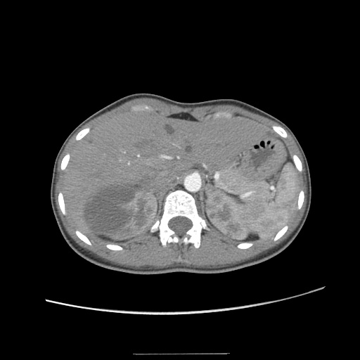 Adult polycystic kidney disease (Radiopaedia 48845-53876 Axial renal cortical phase 10).jpg