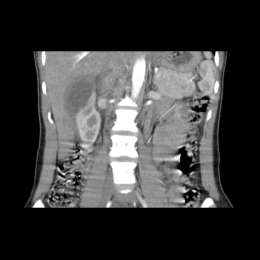 File:Adult polycystic kidney disease (Radiopaedia 48845-53876 Coronal renal cortical phase 19).jpg