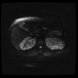 Adult polycystic kidney disease (Radiopaedia 59075-66365 Axial DWI 24).jpg