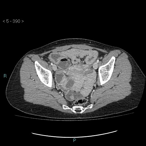 Adult transient intestinal intussusception (Radiopaedia 34853-36310 Axial C+ portal venous phase 101).jpg