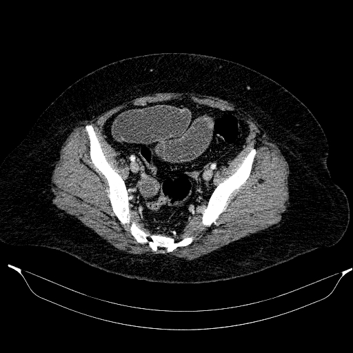 Afferent loop syndrome - secondary to incarcerated trocar site hernia (Radiopaedia 82959-97305 Axial C+ portal venous phase 195).jpg