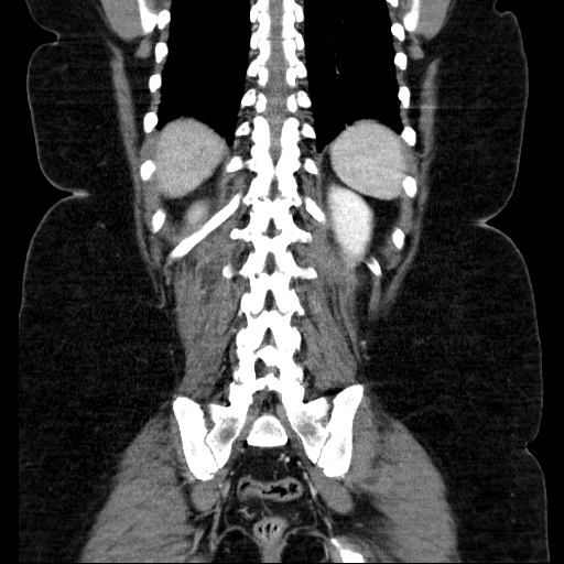 File:Afferent loop syndrome - secondary to incarcerated trocar site hernia (Radiopaedia 82959-97305 Coronal C+ portal venous phase 114).jpg