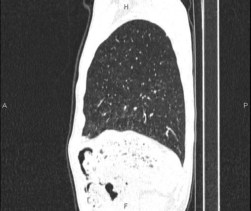 Air bronchogram in pneumonia (Radiopaedia 85719-101512 Sagittal lung window 82).jpg