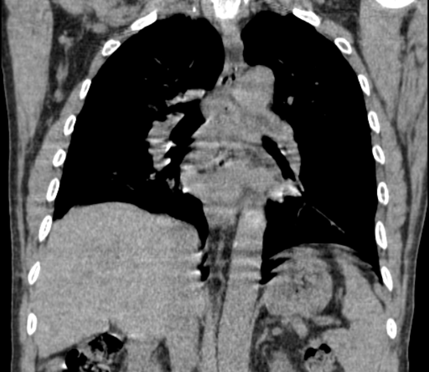 Airway foreign body in adult (Radiopaedia 85907-101779 Coronal liver window 160).jpg