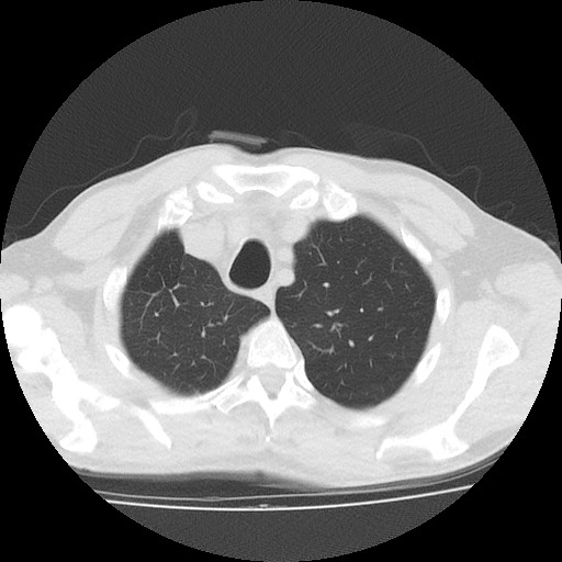 Allergic bronchopulmonary aspergillosis (ABPA) (Radiopaedia 60594-68313 Axial lung window 9).jpg